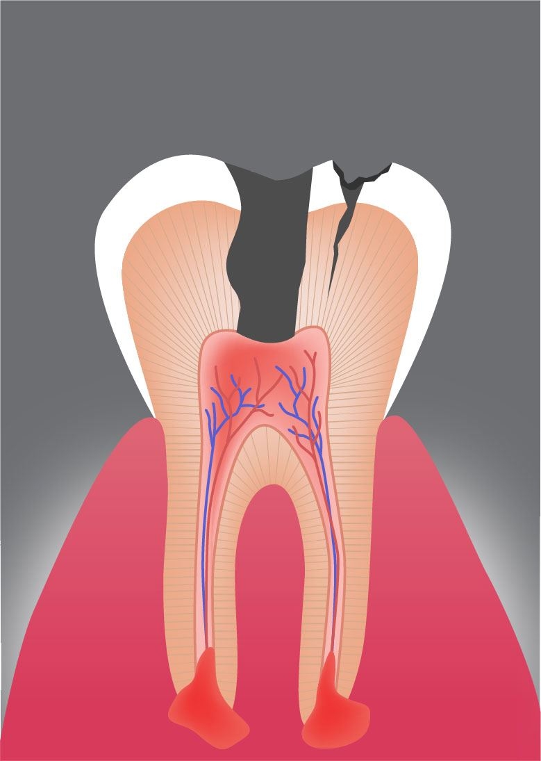 Diagnose: Zunächst wird der betroffene Zahn gründlich untersucht, um das Ausmaß der Schädigung und Entzündung bis zur Zahnwurzel festzustellen.
