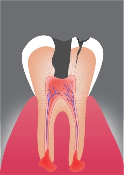 Diagnose: Zunächst wird der betroffene Zahn gründlich untersucht, um das Ausmaß der Schädigung und Entzündung bis zur Zahnwurzel festzustellen.