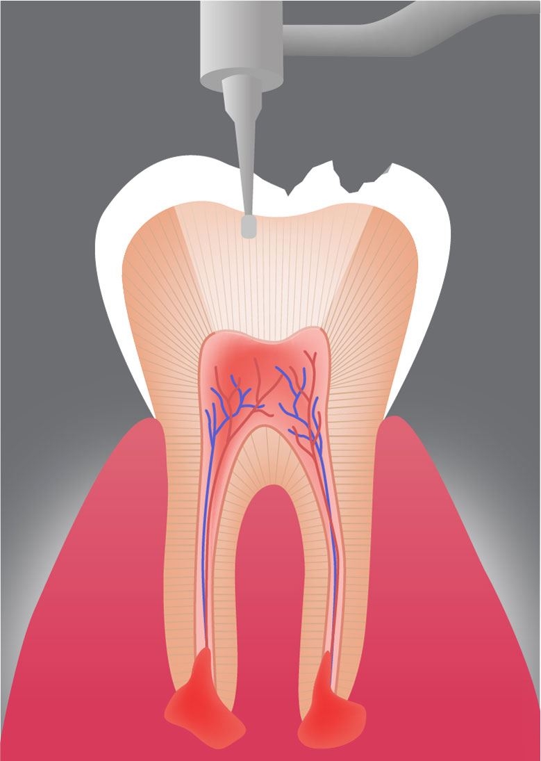 Kariesentfernung und Zugang zu den Wurzelkanälen: Unter lokaler Betäubung werden die kariösen Stellen sorgfältig entfernt. Anschließend wird der Zugang zu den Wurzelkanälen freigelegt.