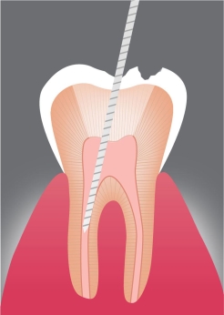 Entfernung des entzündeten Zahnmarks: Mit speziellen dentalen Instrumenten wird das entzündete oder abgestorbene Zahnmark aus den Wurzelkanälen entfernt. 