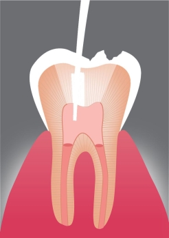 Bakteriendichter Verschluss der Wurzelkanäle: Die gereinigten Wurzelkanäle werden mit einer speziellen Wurzelfüllung bakteriendicht verschlossen, um eine erneute Infektion zu verhindern.