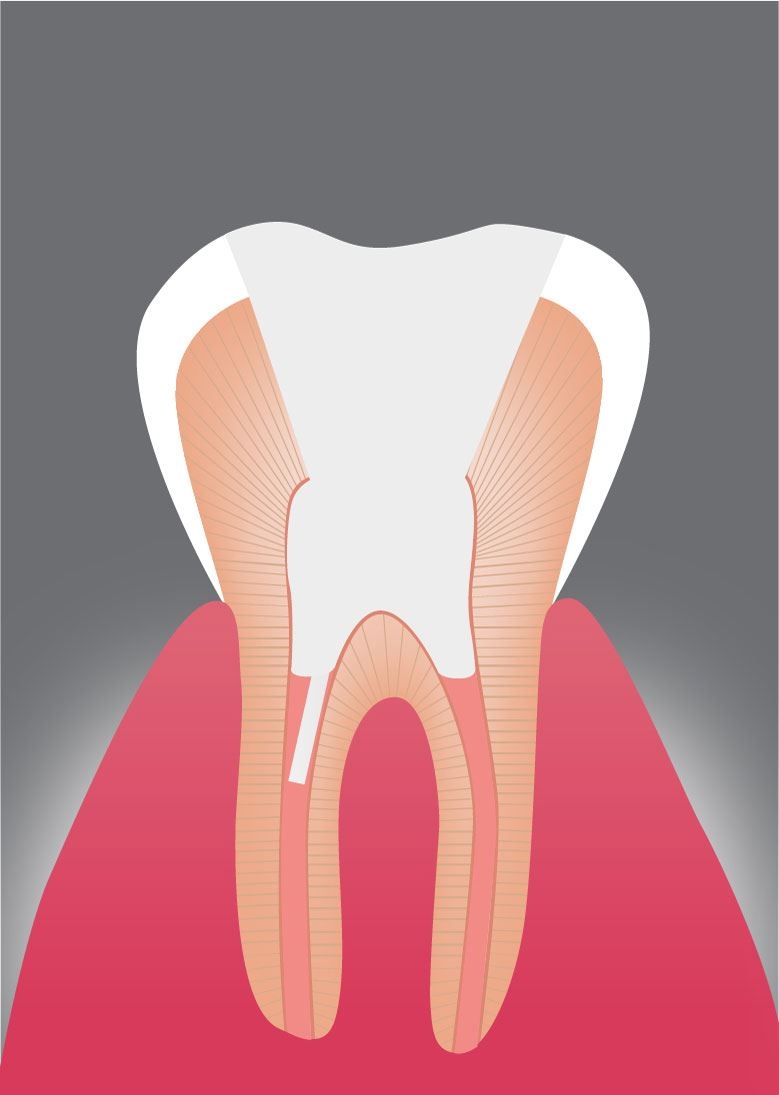 Stabilisierung des Zahns: Ein Glasfaserstift wird in den Wurzelkanal eingebracht, um die Stabilität des Zahns zu gewährleisten und die Basis für die nachfolgende Versorgung zu schaffen.