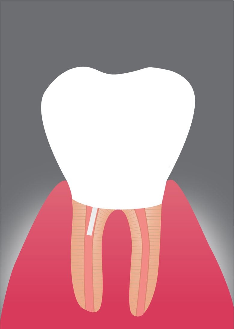 Überkronung des Zahns: Abschließend wird der wurzelbehandelte Zahn mit einer keramischen Krone versorgt, die sowohl ästhetisch ansprechend als auch funktional langlebig ist.